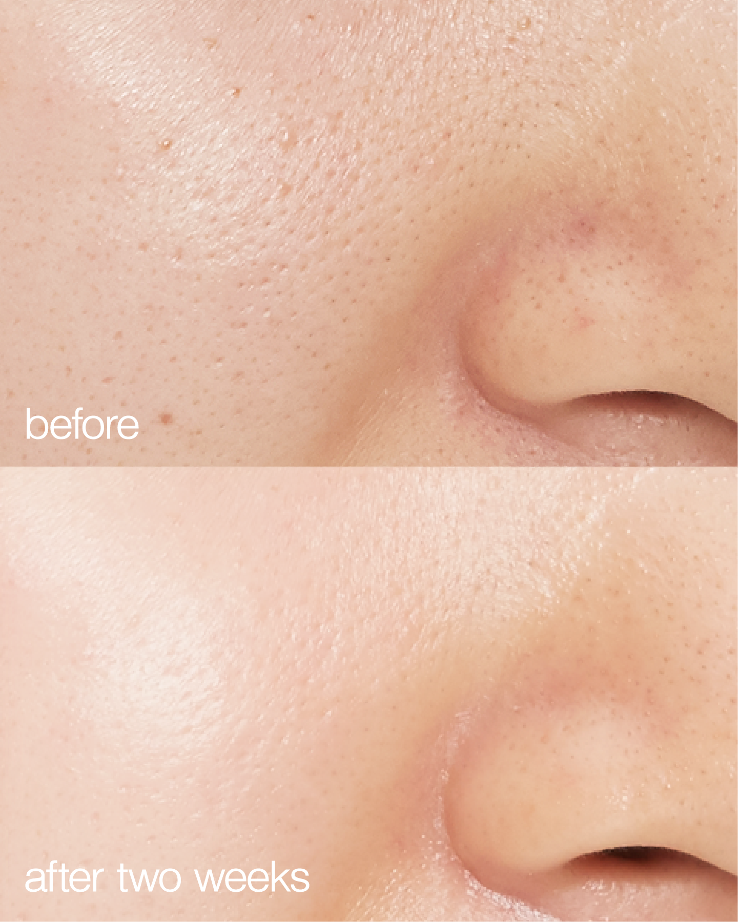 biome boost cream daily moisturizer before and after pictures. Pores have  been visibly reduced and redness gone.